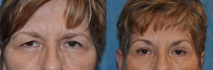 Before & After Eyelid Lift Case 285 View #1 View in Toledo, Ohio