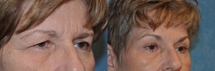 Before & After Eyelid Lift Case 285 View #2 View in Toledo, Ohio
