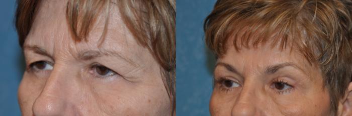 Before & After Eyelid Lift Case 285 View #3 View in Toledo, Ohio