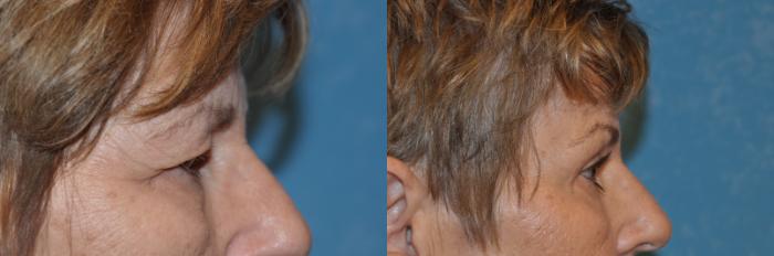 Before & After Eyelid Lift Case 285 View #5 View in Toledo, Ohio