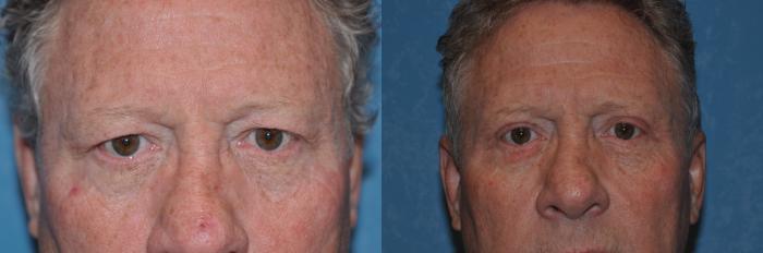 Before & After Eyelid Lift Case 286 View #1 View in Toledo, Ohio