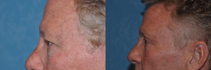 Before & After Eyelid Lift Case 286 View #3 View in Toledo, Ohio