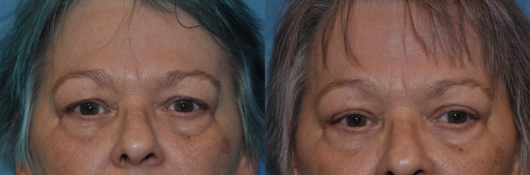 Before & After Eyelid Lift Case 319 View #1 View in Toledo, Ohio