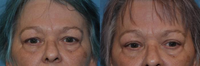 Before & After Eyelid Lift Case 319 View #1 View in Toledo, Ohio