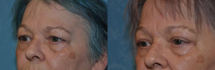 Before & After Eyelid Lift Case 319 View #3 View in Toledo, Ohio