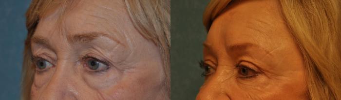 Before & After Eyelid Lift Case 361 View #2 View in Toledo, Ohio