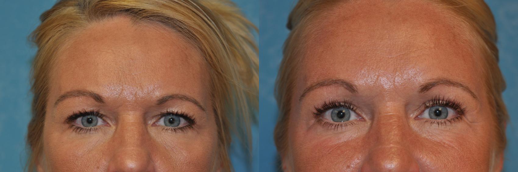 Before & After Eyelid Lift Case 396 Front View in Toledo, Ohio