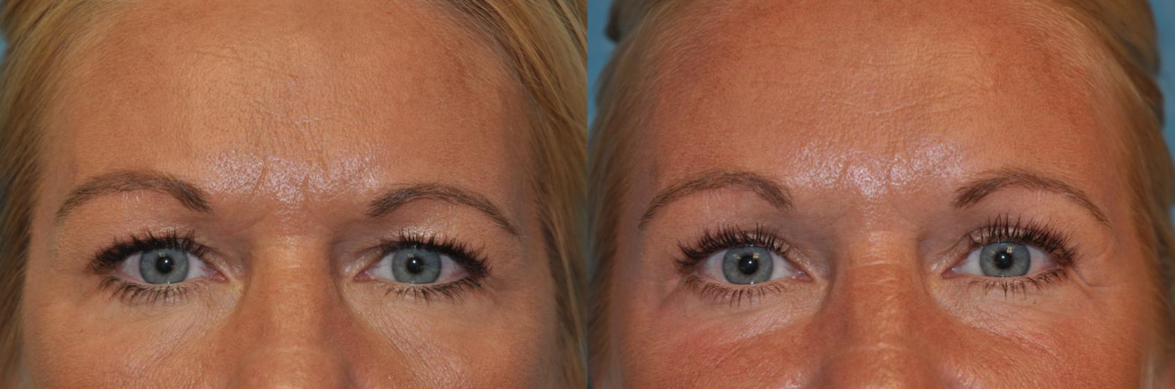 Before & After Eyelid Lift Case 396 Front View in Toledo, Ohio