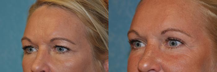 Before & After Eyelid Lift Case 396 Left Oblique View in Toledo, Ohio