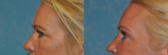 Before & After Eyelid Lift Case 396 Left Side View in Toledo, Ohio