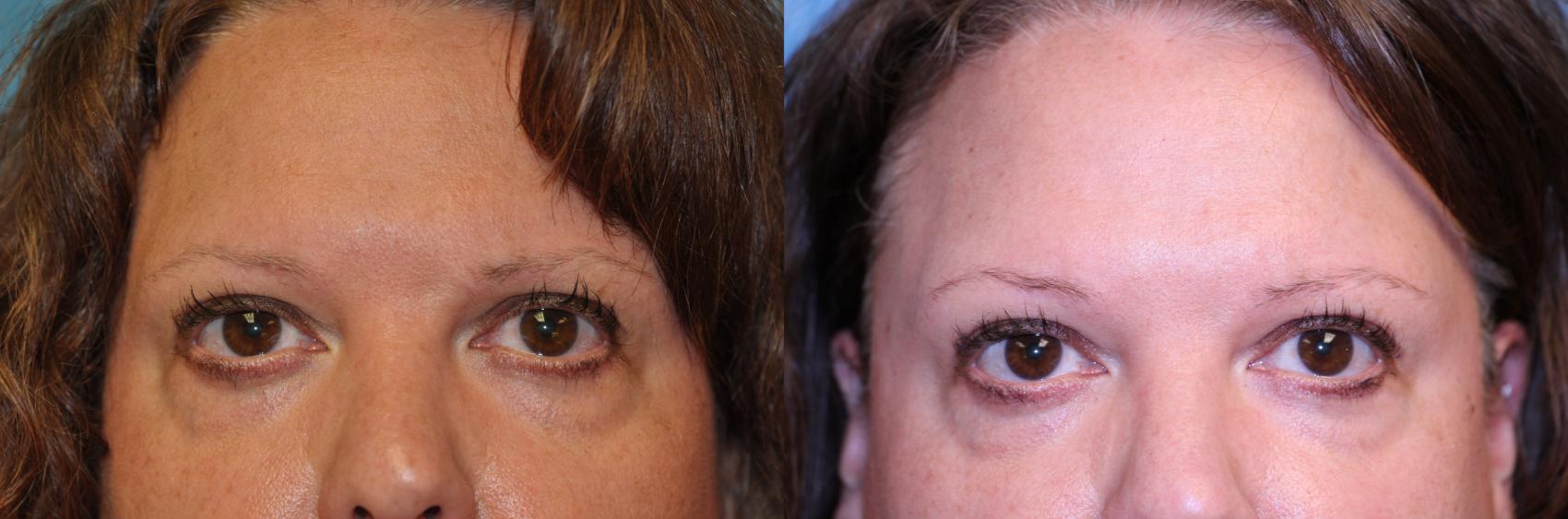 Before & After Eyelid Lift Case 449 Front View in Toledo, Ohio