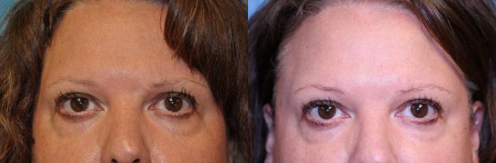 Before & After Eyelid Lift Case 449 Front View in Toledo, Ohio