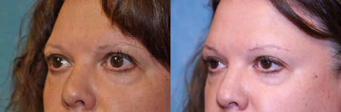 Before & After Eyelid Lift Case 449 Left Oblique View in Toledo, Ohio