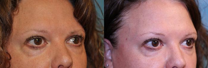 Before & After Eyelid Lift Case 449 Right Oblique View in Toledo, Ohio