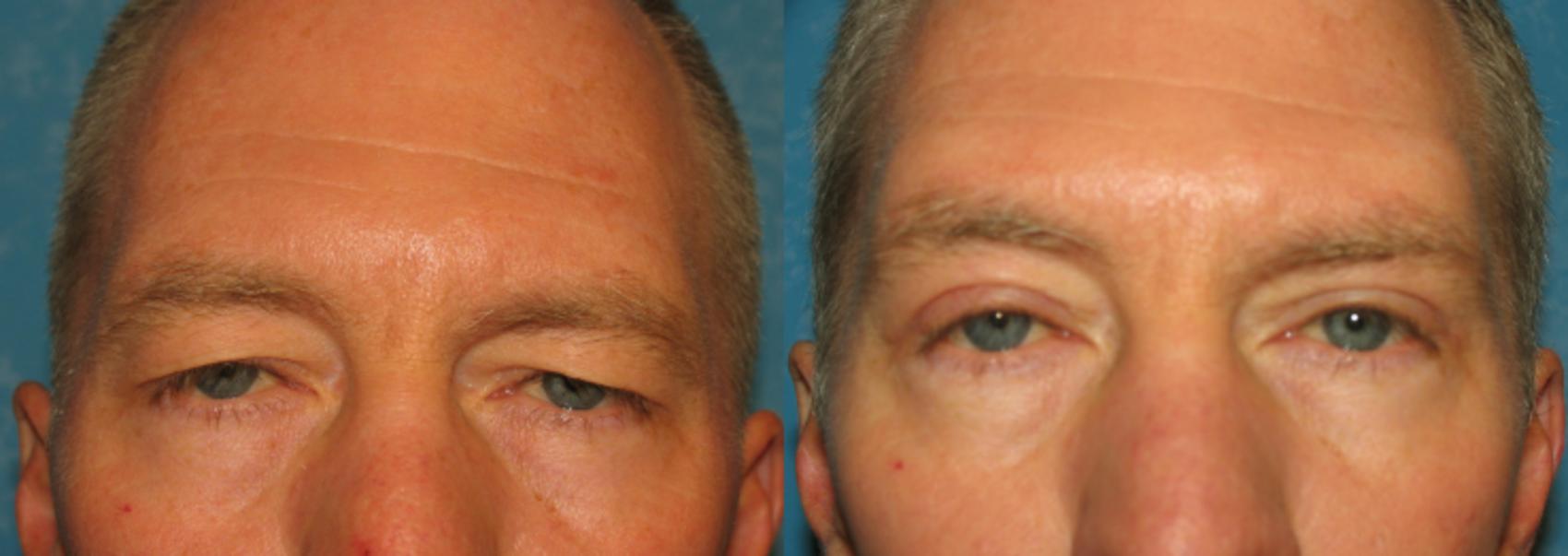 Before & After Eyelid Lift Case 92 View #1 View in Toledo, Ohio