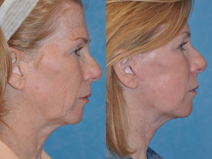 Before & After Face Lift Case 210 Right Side View in Toledo, Ohio