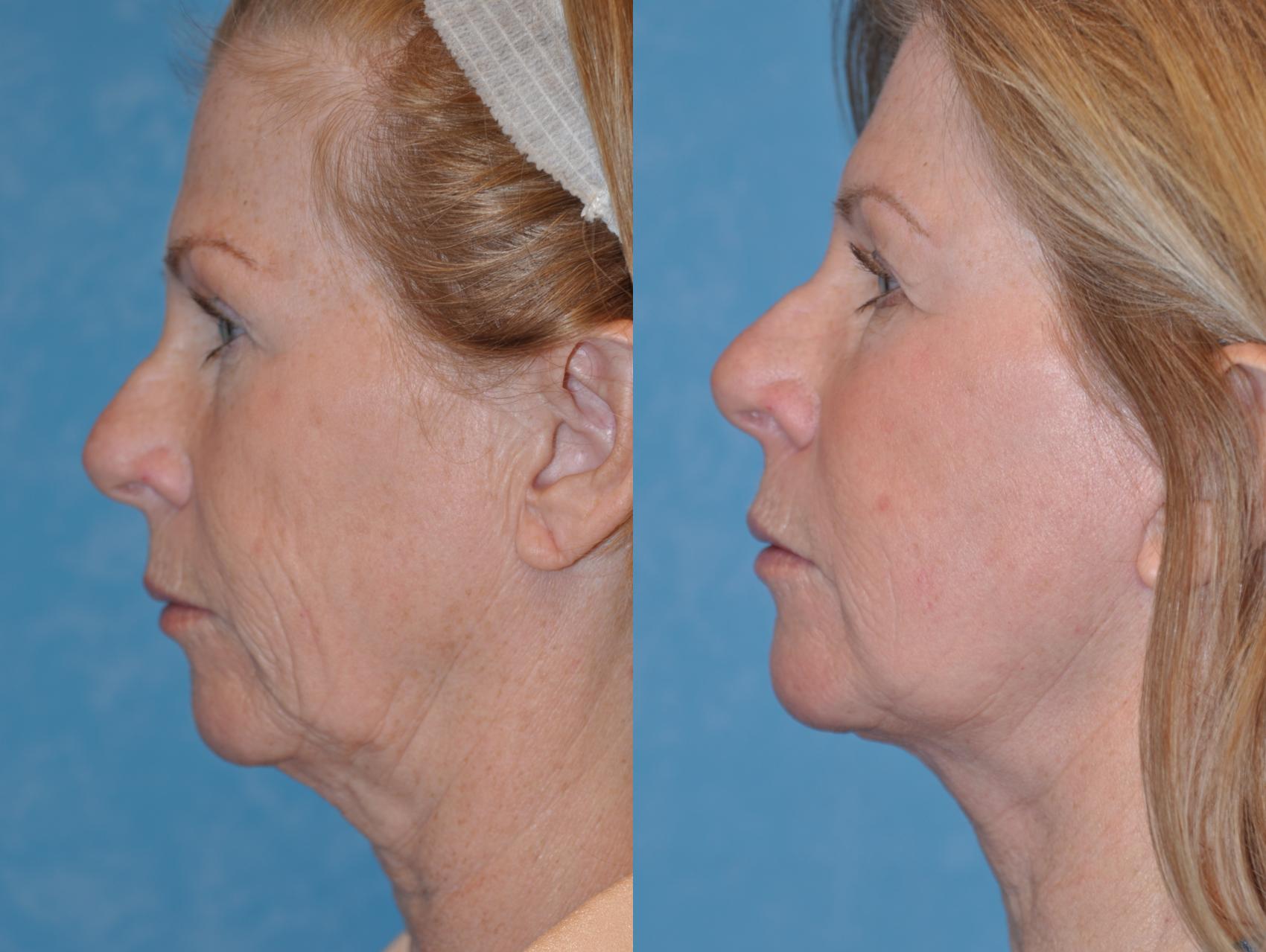 Facelift In Toledo Ohio Dr Craig Colville