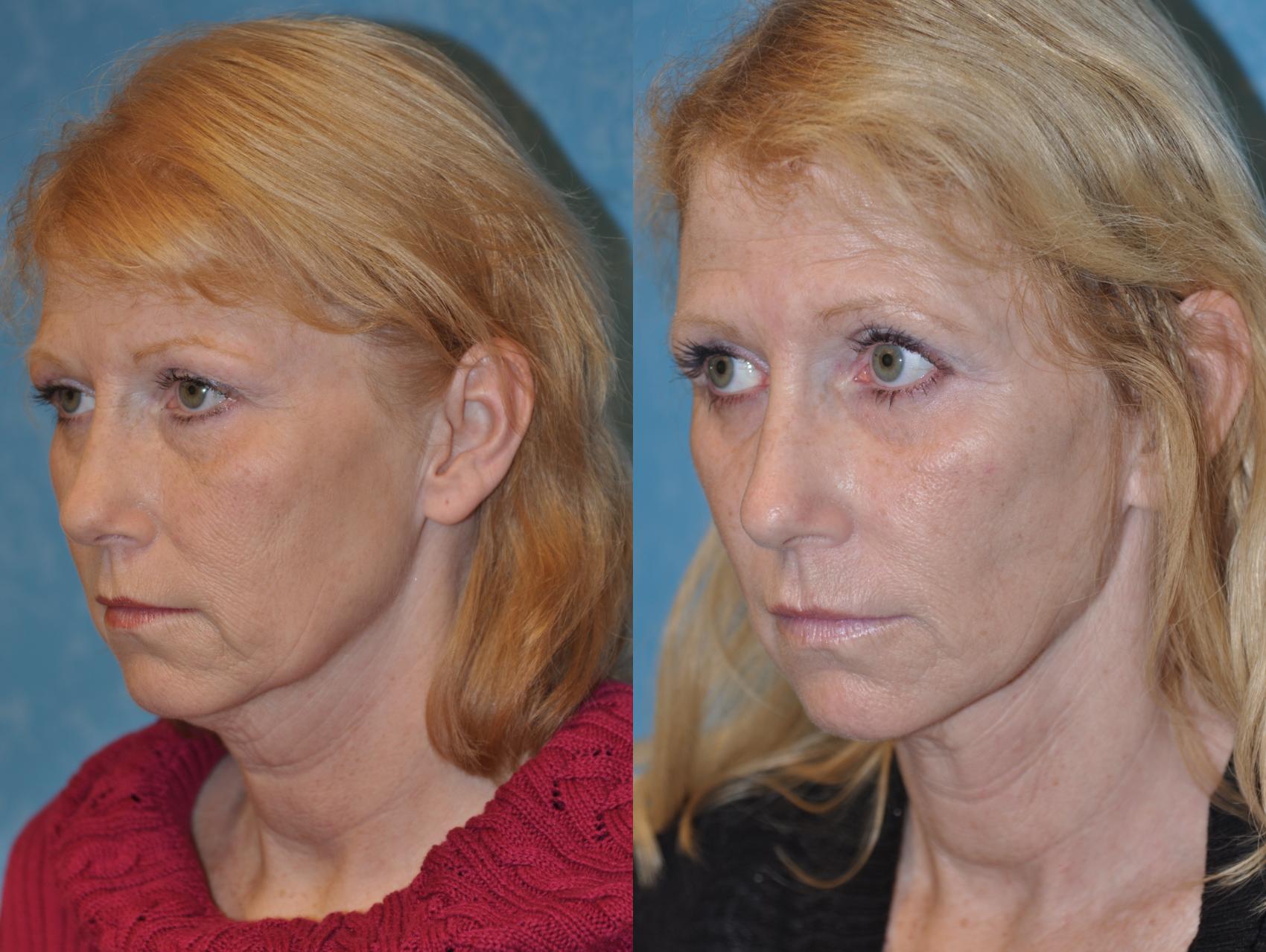 Facelift In Toledo Ohio Dr Craig Colville