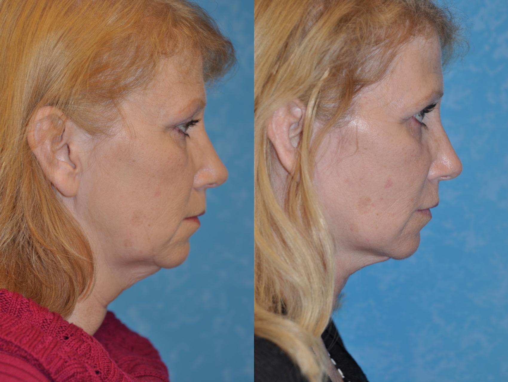 Before & After Face Lift Case 212 View #3 View in Toledo, Ohio