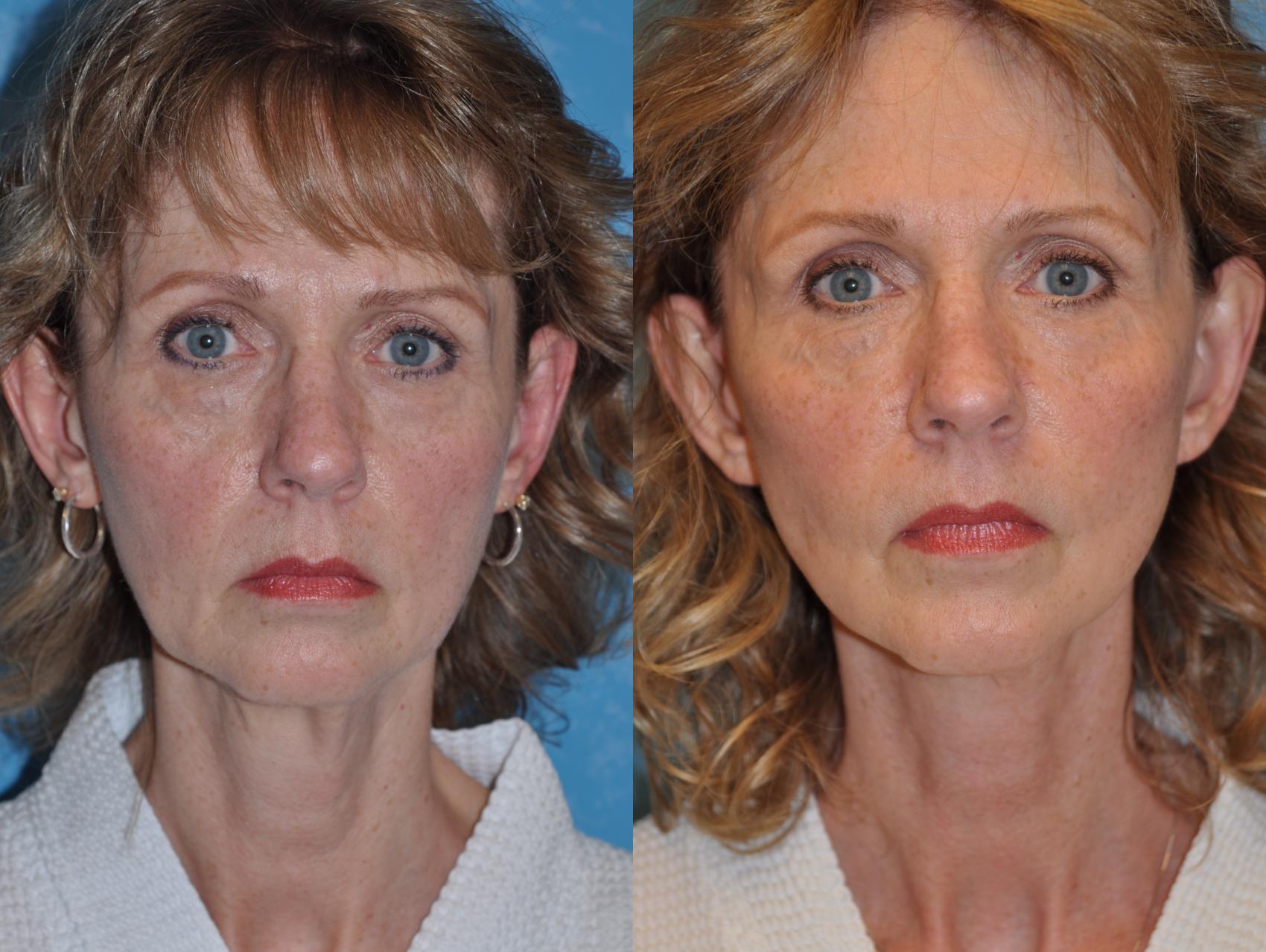 Facelift, Neck Lift and Fat Grafting - Clinical Case #14098-1