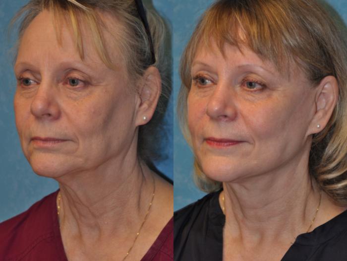 Before & After Face Lift Case 362 Left Oblique View in Toledo, Ohio