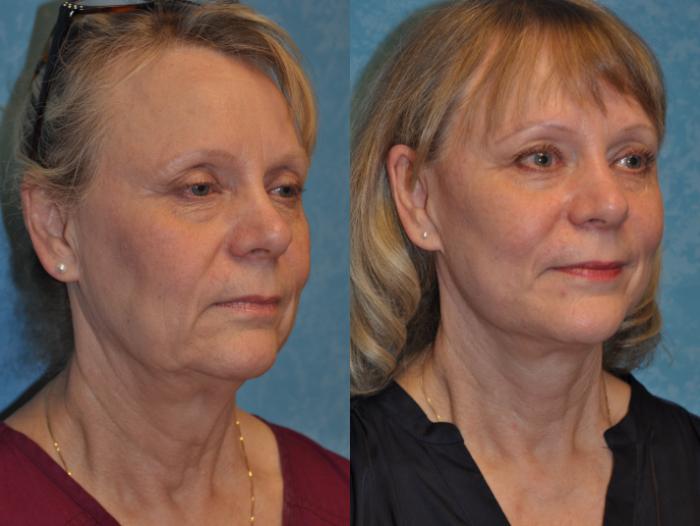 Before & After Face Lift Case 362 Right Oblique View in Toledo, Ohio