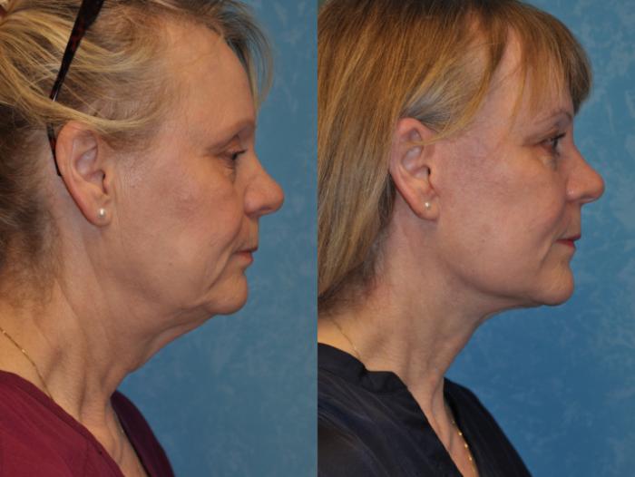 Before & After Face Lift Case 362 Right Side View in Toledo, Ohio