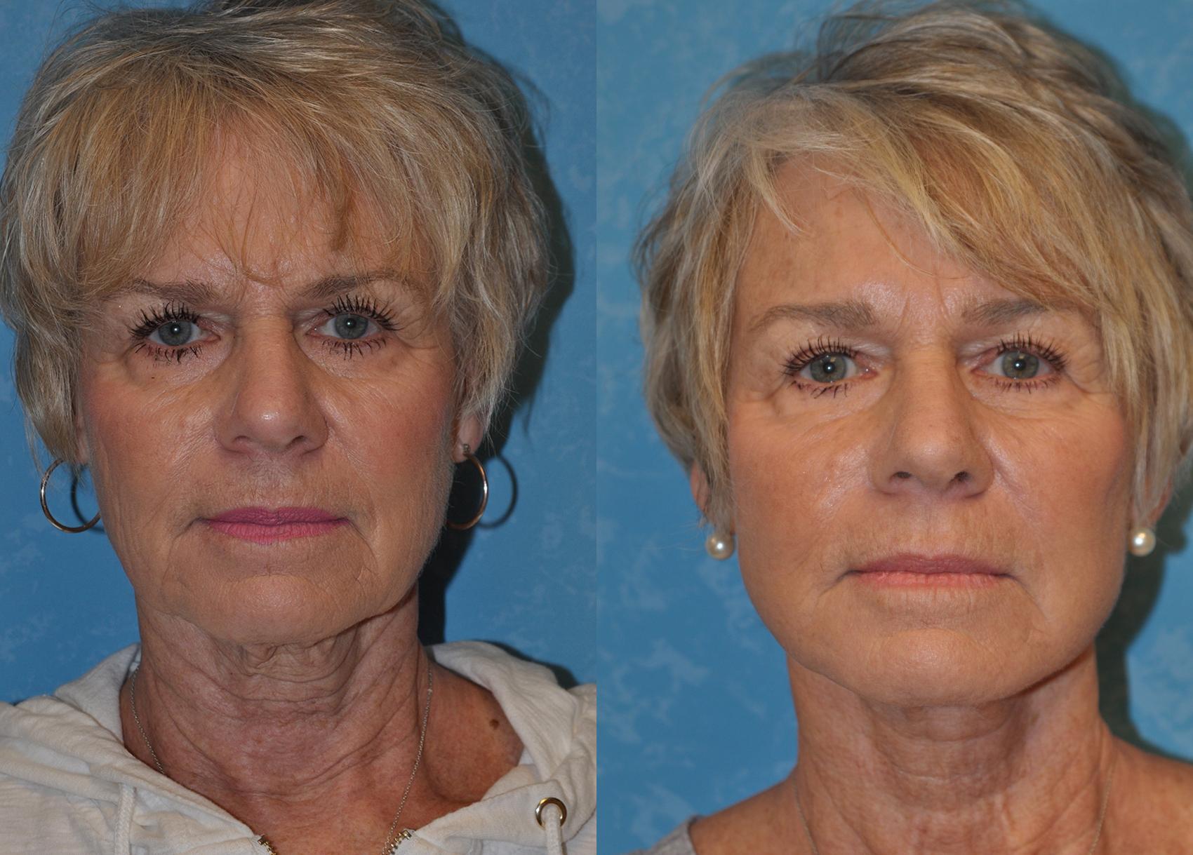 Before & After Face Lift Case 363 Front View in Toledo, Ohio