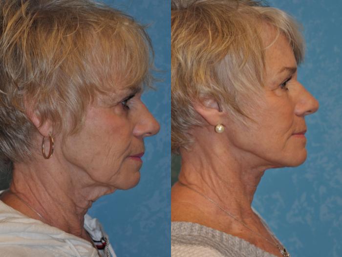 Before & After Face Lift Case 363 Right Side View in Toledo, Ohio