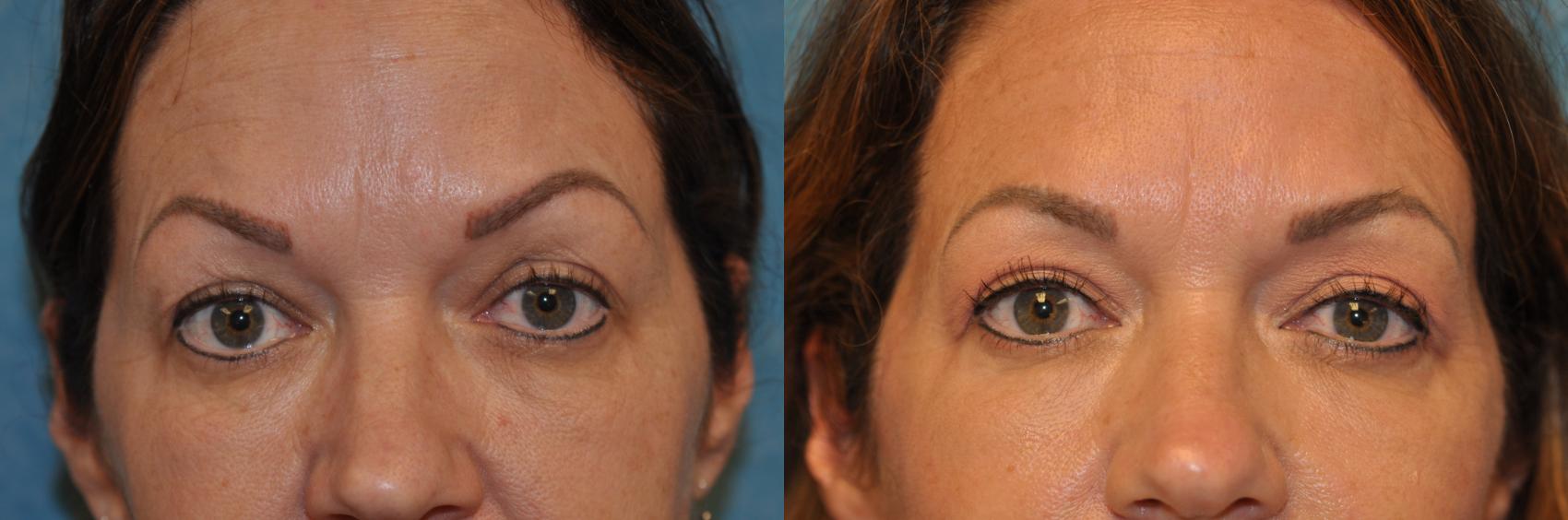 Before & After Eyelid Lift Case 414 Front View in Toledo, Ohio