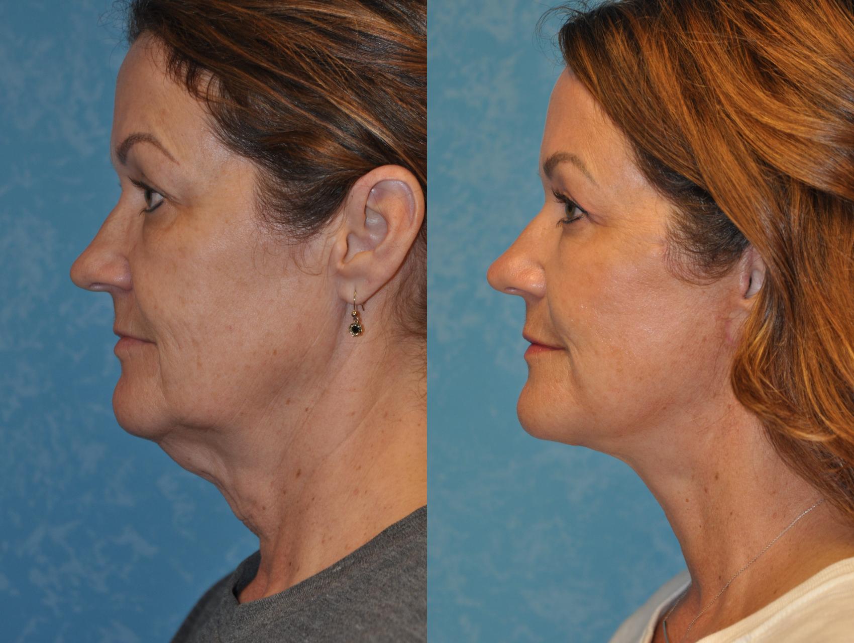 Before & After Neck Lift Case 414 Left Side View in Toledo, Ohio