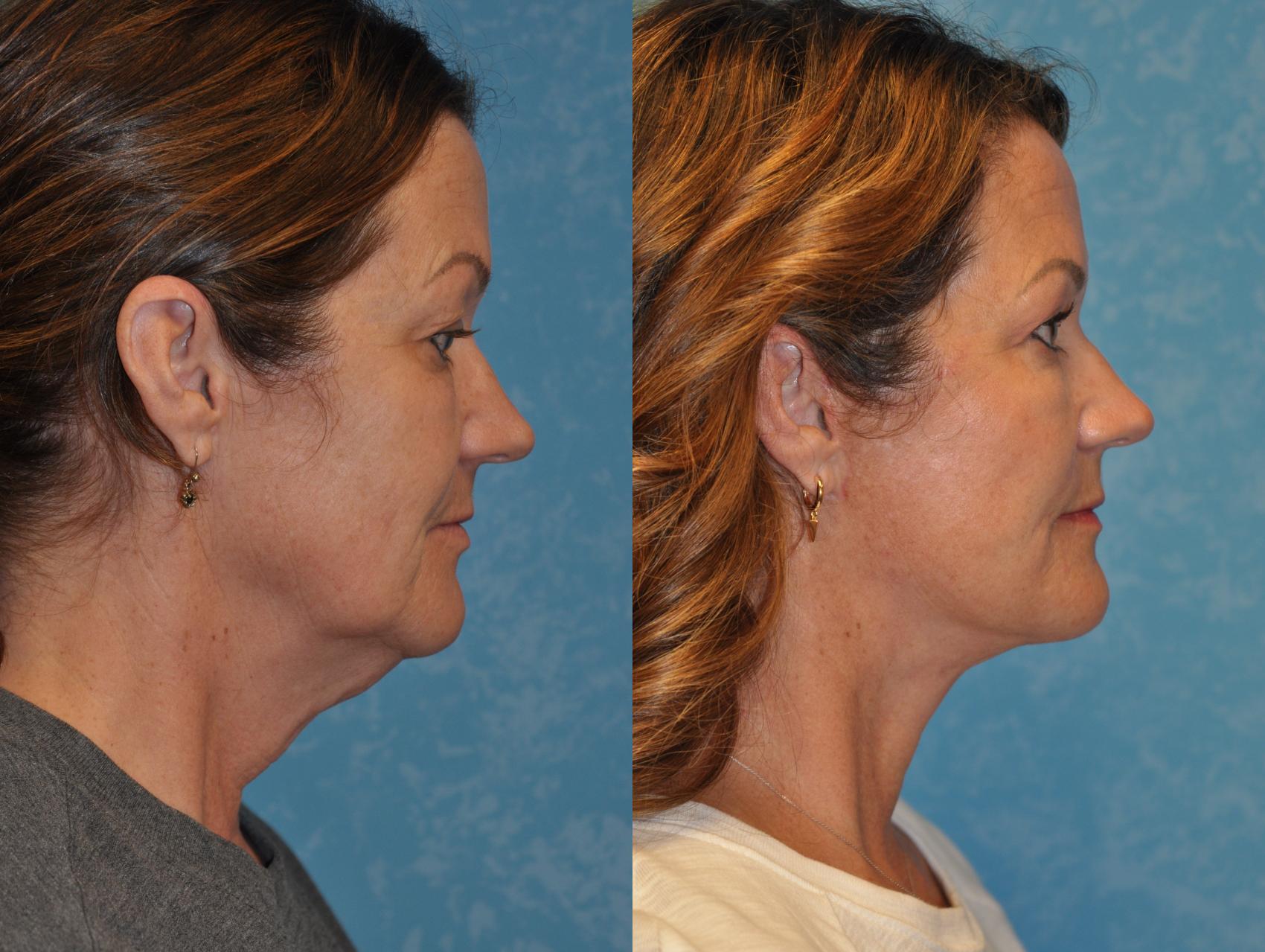 Before & After Eyelid Lift Case 414 Right Side View in Toledo, Ohio