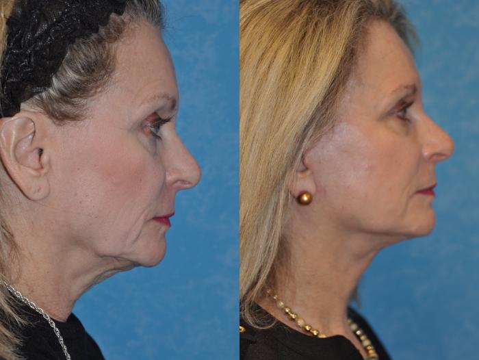 Before & After Face Lift Case 448 Right Side View in Toledo, Ohio