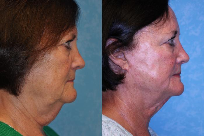 Before & After Face Lift Case 453 Right Side View in Toledo, Ohio
