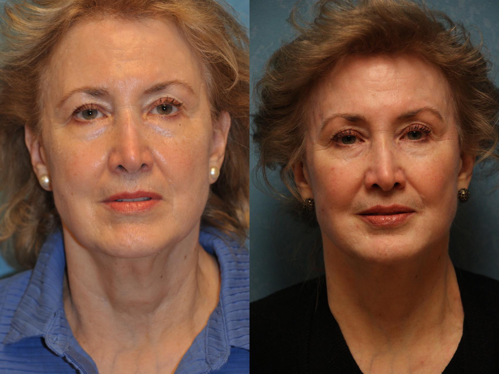 Before & After Eyelid Lift Case 476 Front View in Toledo, Ohio