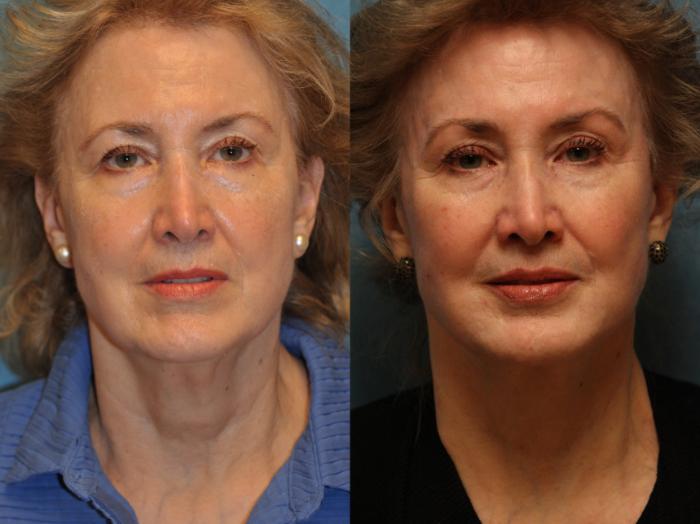 Before & After Neck Lift Case 476 Front View in Toledo, Ohio