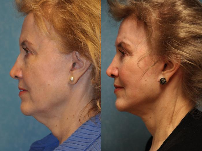 Before & After Neck Lift Case 476 Left Side View in Toledo, Ohio