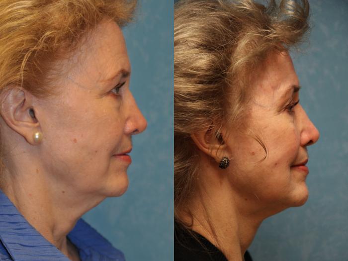 Before & After Eyelid Lift Case 476 Right Side View in Toledo, Ohio