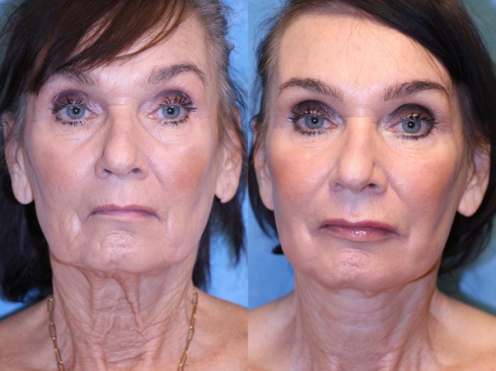 Before & After Neck Lift Case 521 Front View in Toledo, Ohio