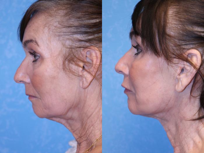 Before & After Neck Lift Case 521 Left Side View in Toledo, Ohio