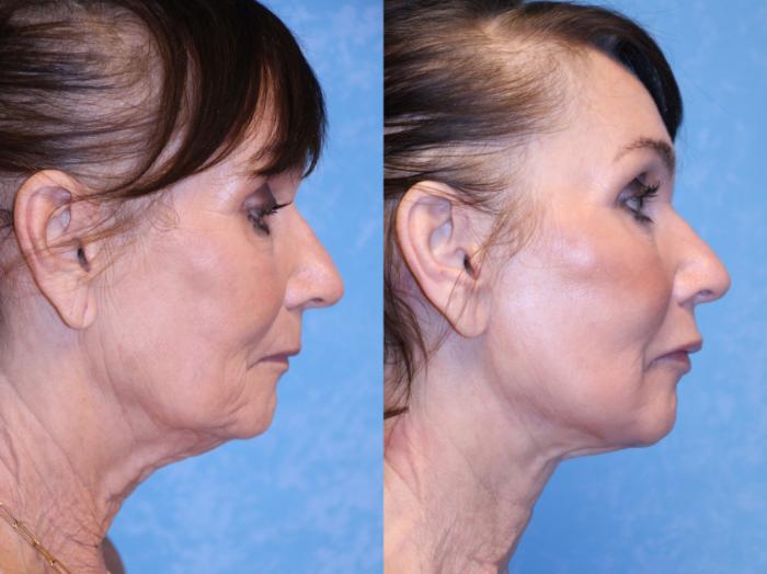 Before & After Face Lift Case 521 Right Side View in Toledo, Ohio