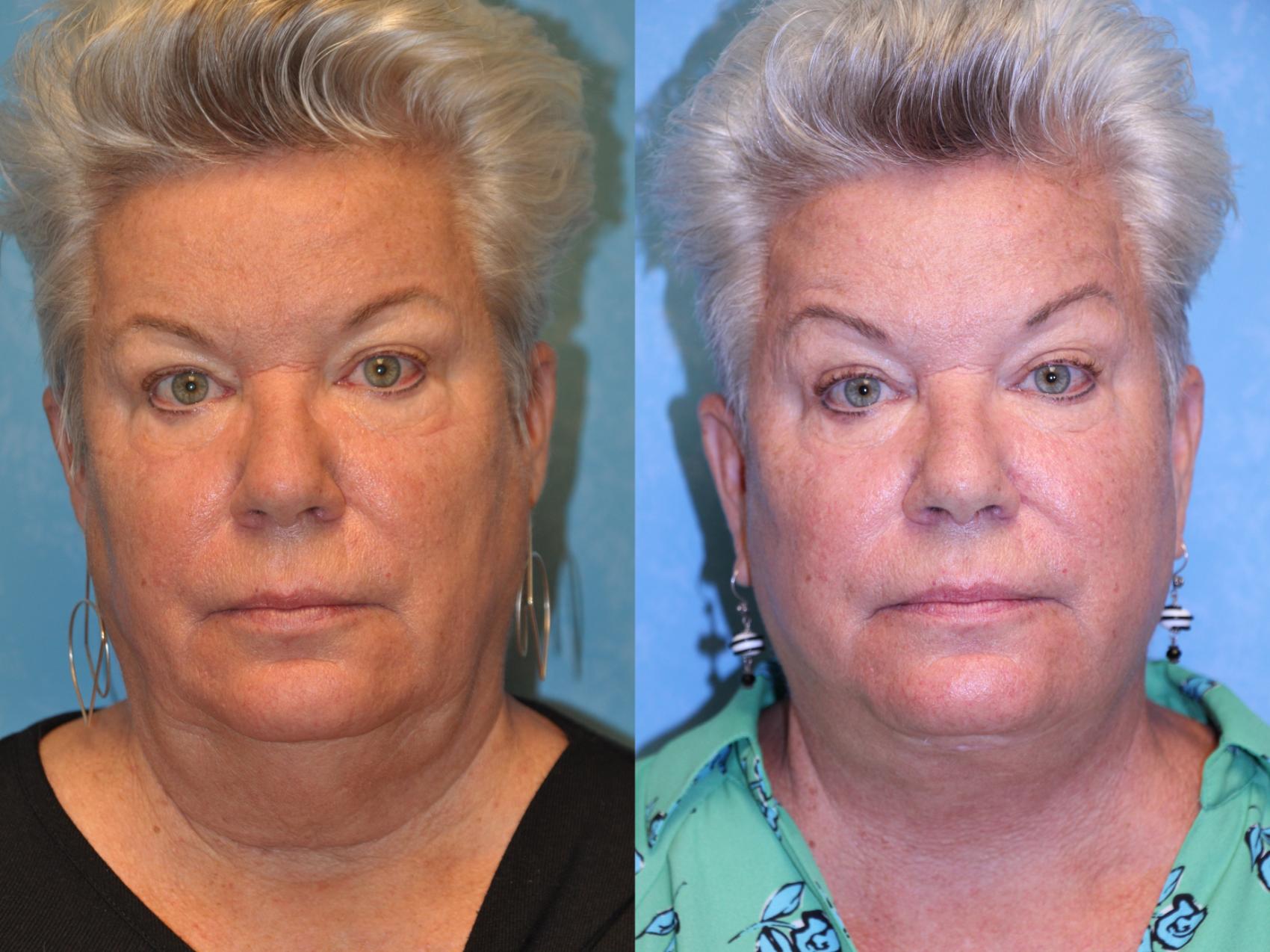 Before & After Neck Lift Case 541 Front View in Toledo, Ohio