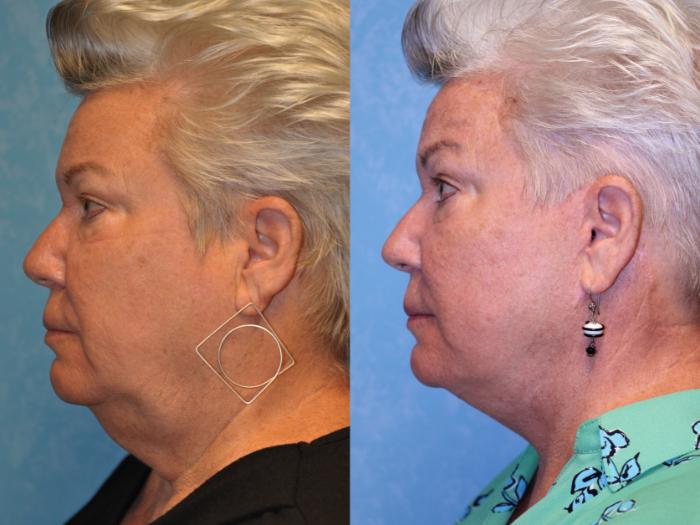 Before & After Brow Lift Case 541 Left Side View in Toledo, Ohio