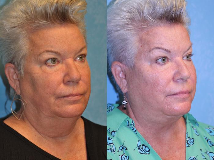Before & After Brow Lift Case 541 Right Oblique View in Toledo, Ohio