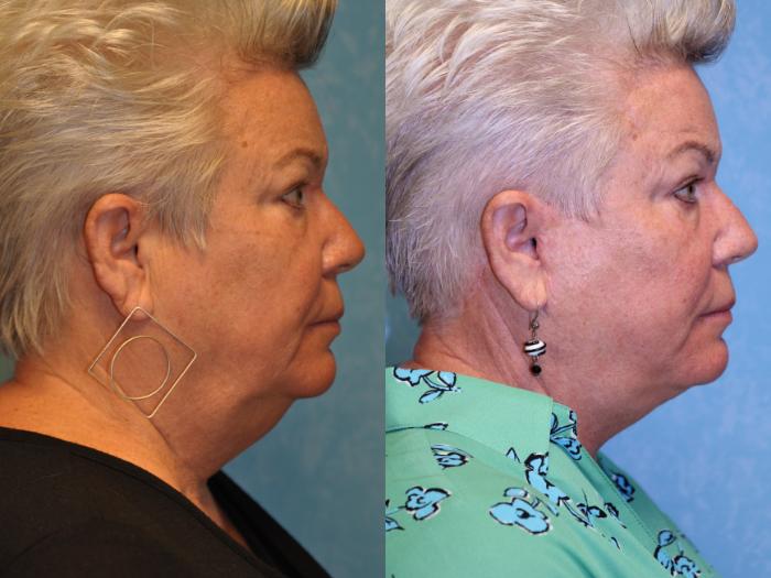 Before & After Neck Lift Case 541 Right Side View in Toledo, Ohio