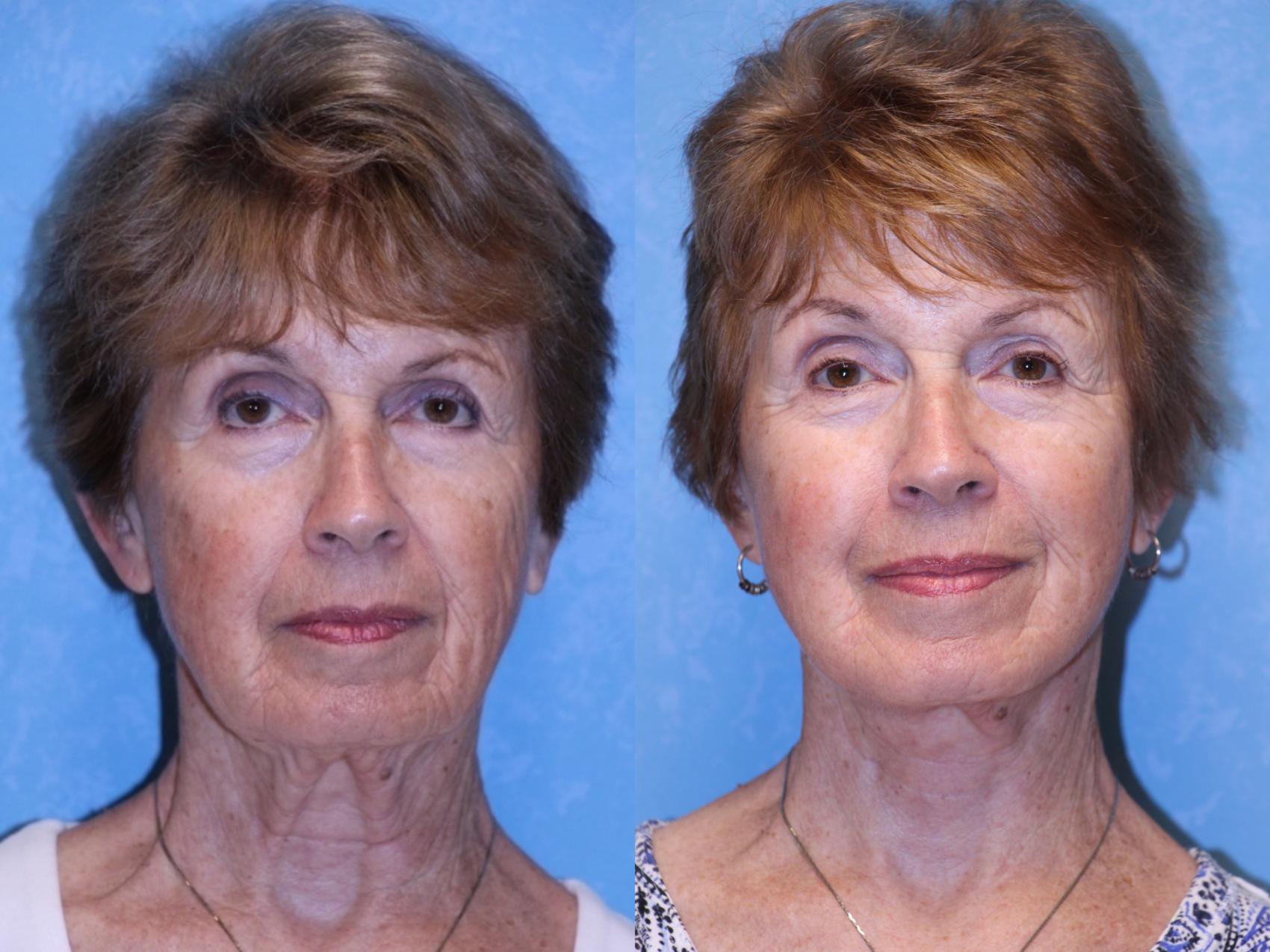 Before & After Face Lift Case 554 Front View in Toledo, Ohio