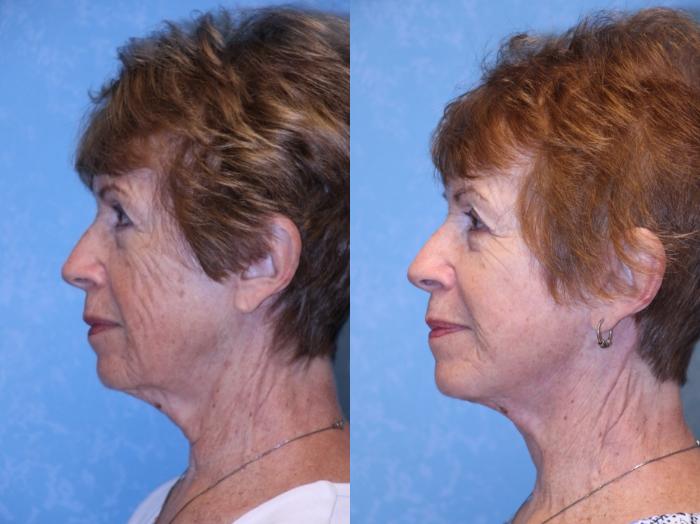 Before & After Face Lift Case 554 Left Side View in Toledo, Ohio
