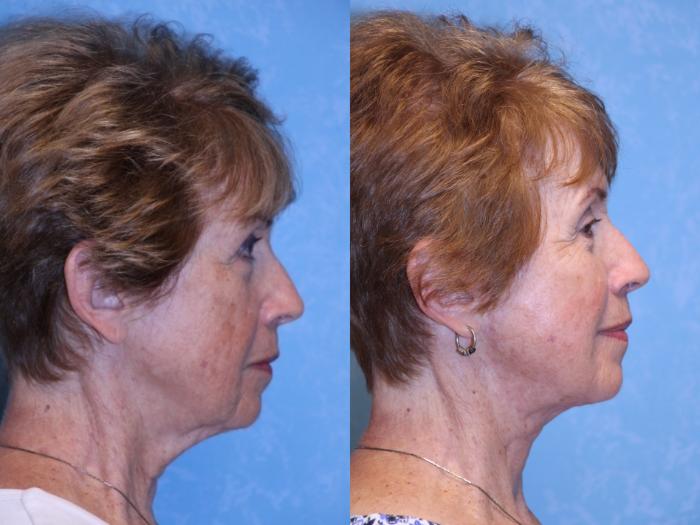 Before & After Face Lift Case 554 Right Side View in Toledo, Ohio