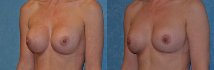 Before & After Implant Revision Case 201 View #2 View in Toledo, Ohio