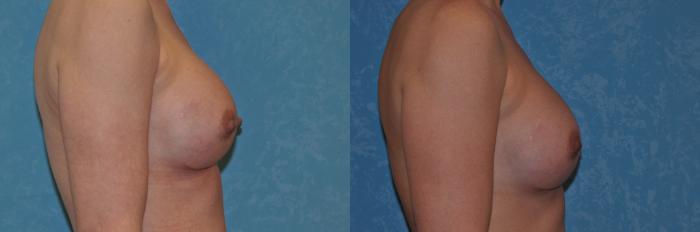 Before & After Implant Revision Case 201 View #3 View in Toledo, Ohio